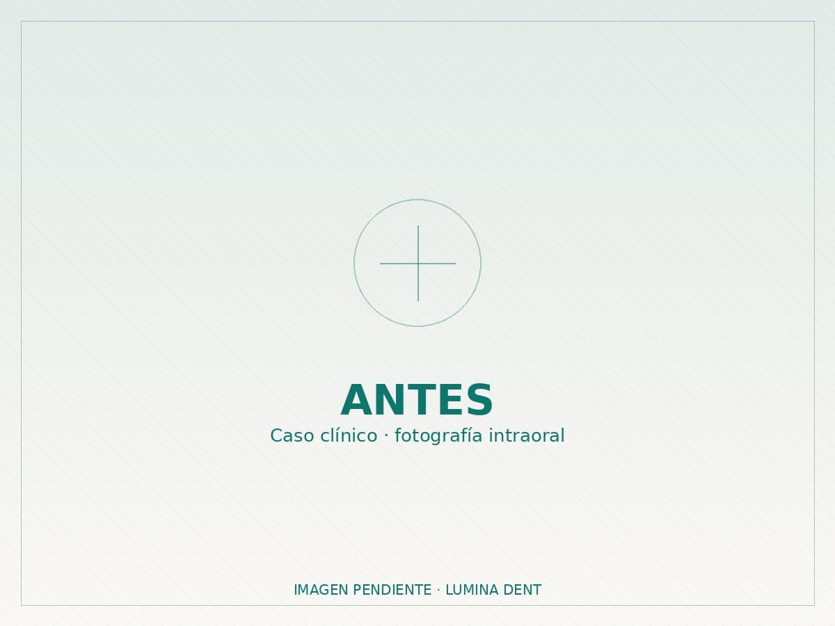 Cambio Antes y Después Ortodoncia Brackets Convencionales — situación antes del tratamiento